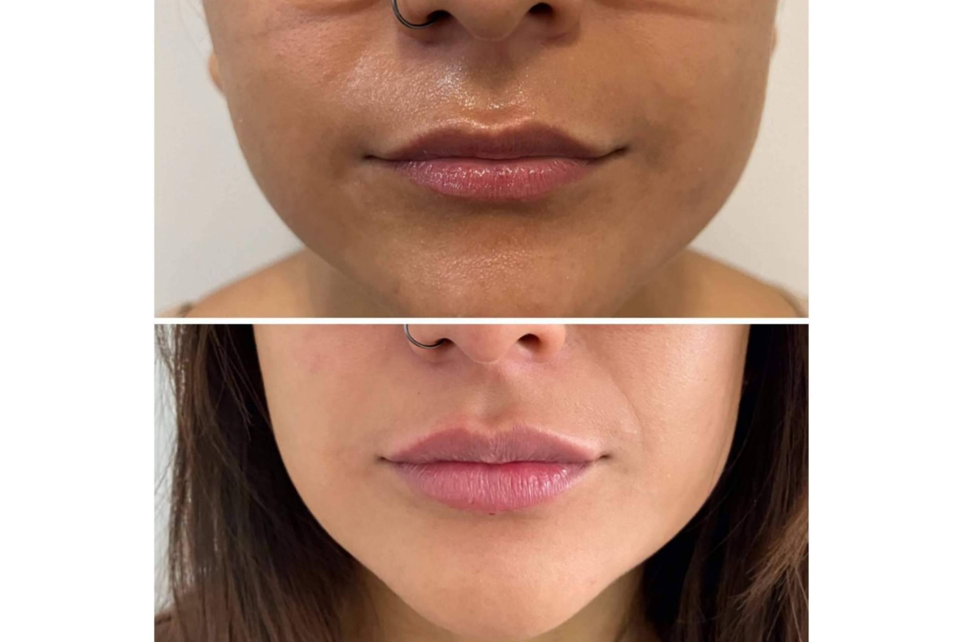 ¿Se puede conseguir un aumento de labios en Madrid con resultados naturales?, por la Dra. Cecilia Arthur