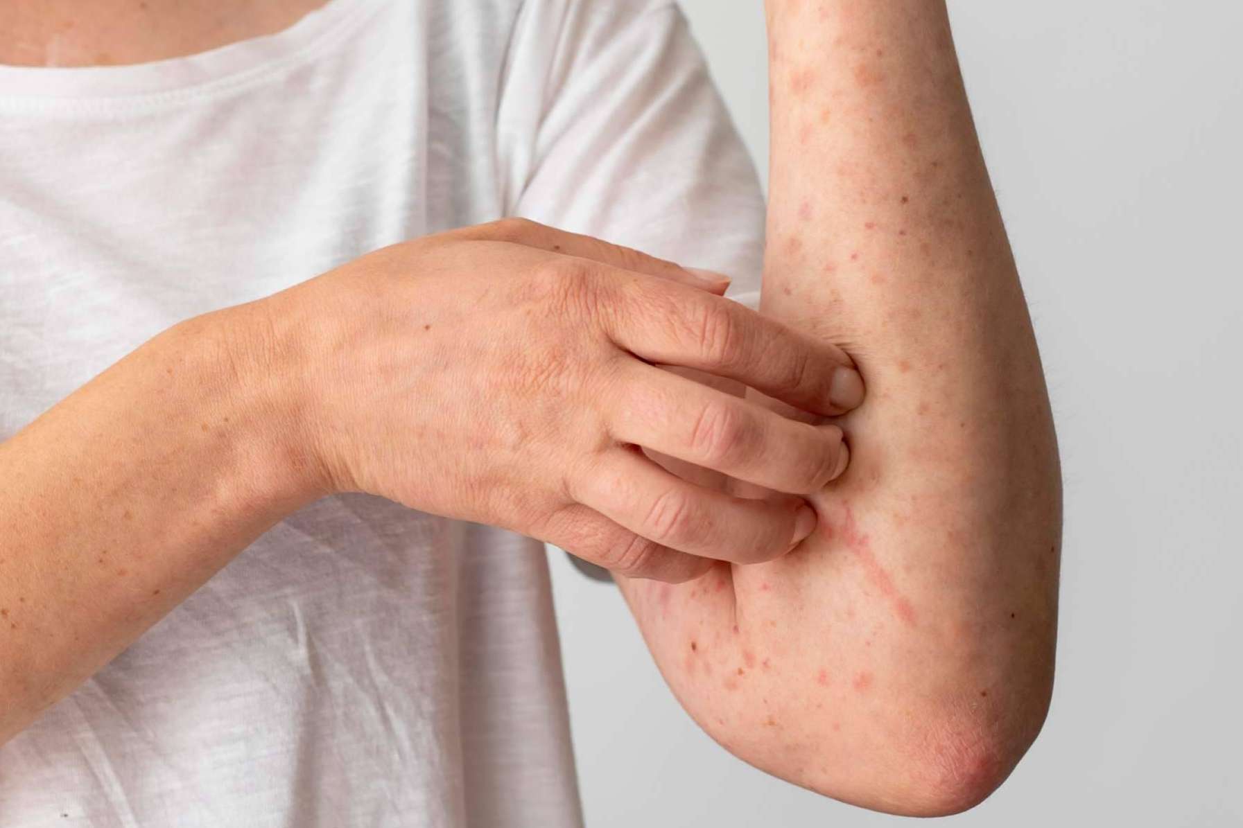 Novopiel, el superhéroe de los luchadores contra el eczema