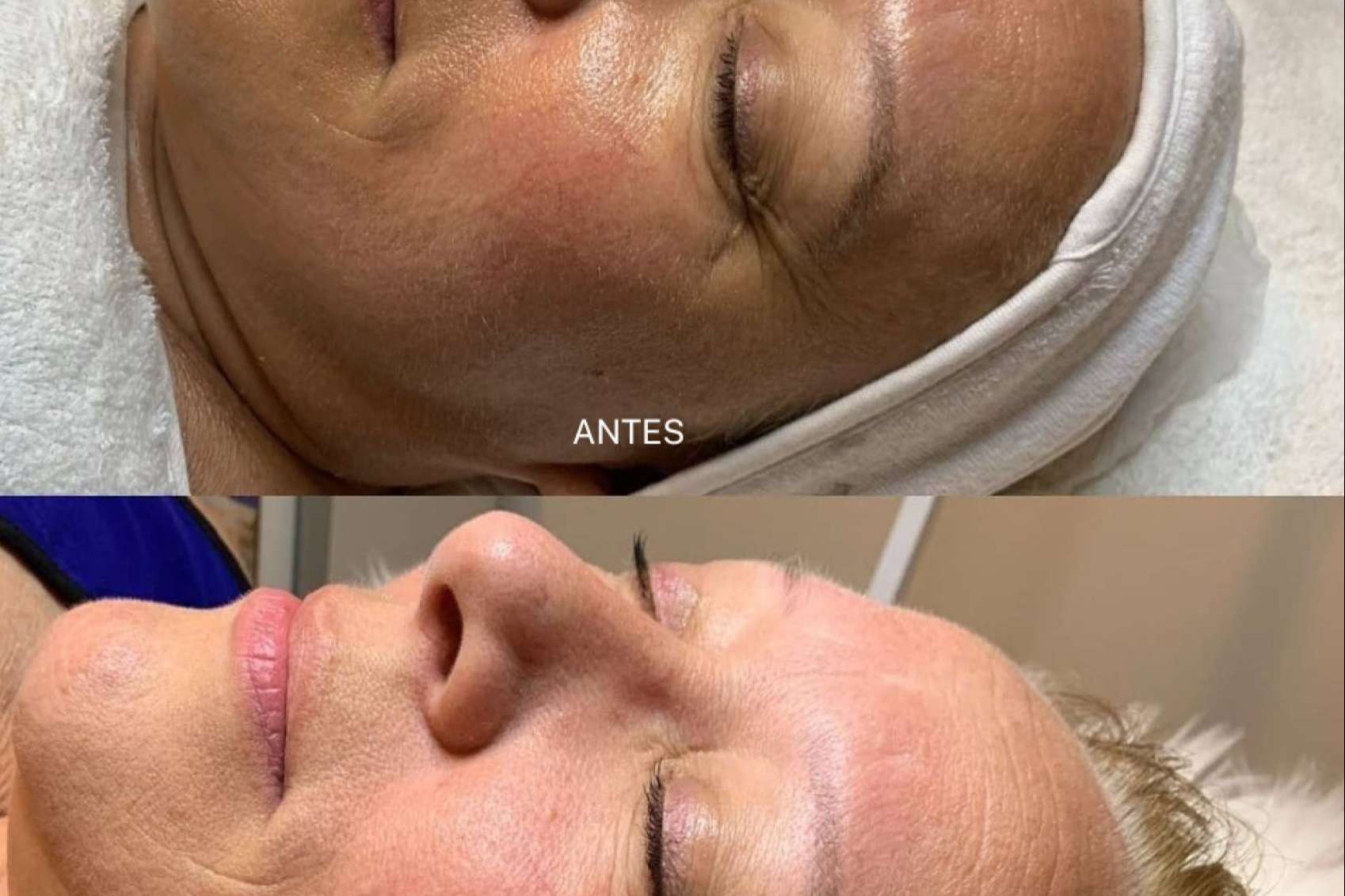 Vortex Peel, uno de los mejores peelings de alta intensidad