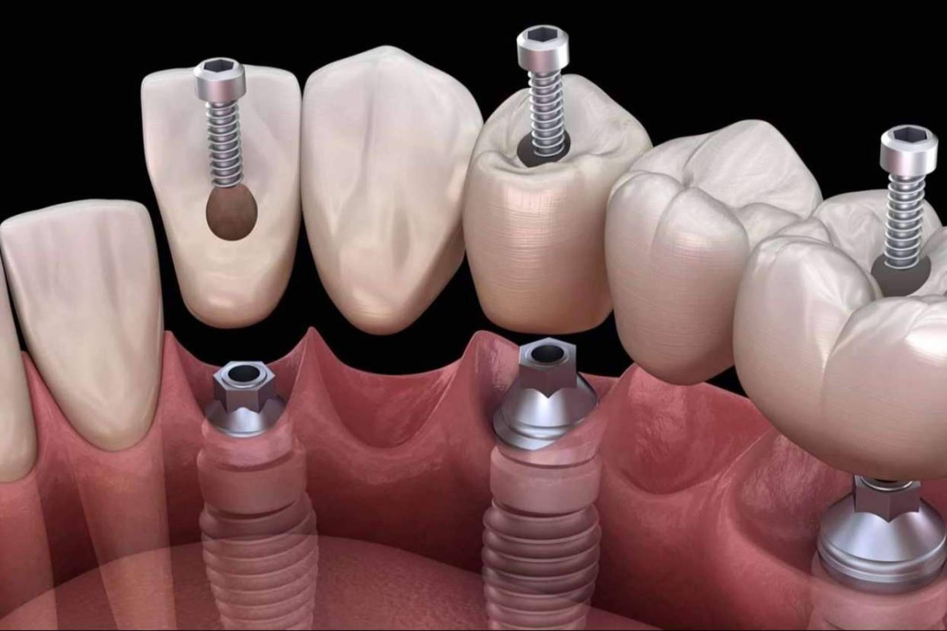 El servicio de colocación de implantes de Dental Implantologie