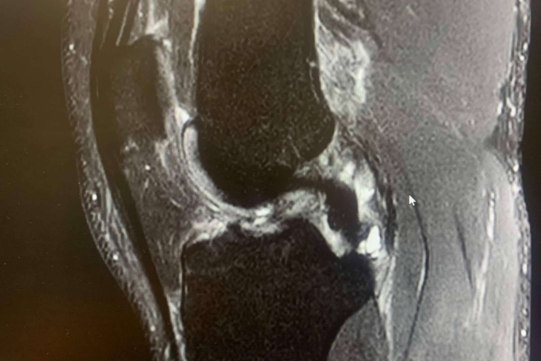 La prevención de las lesiones de ligamento cruzado anterior, por Regeneractiva