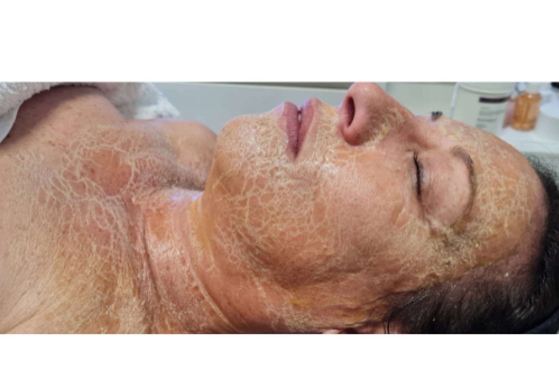 La revolución en los centros de estética, mascarilla enzimática cosmedique