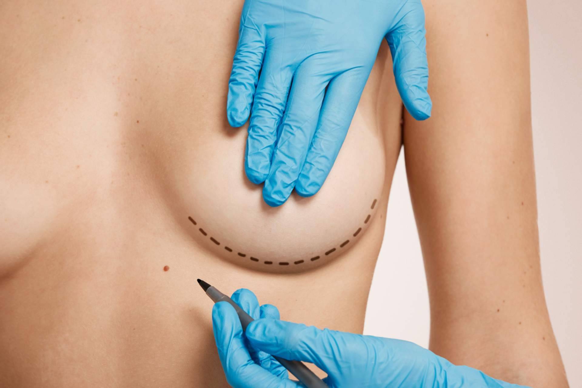 Clínicas Beauty&Beauty, expertos en corrección de mamas tuberosas