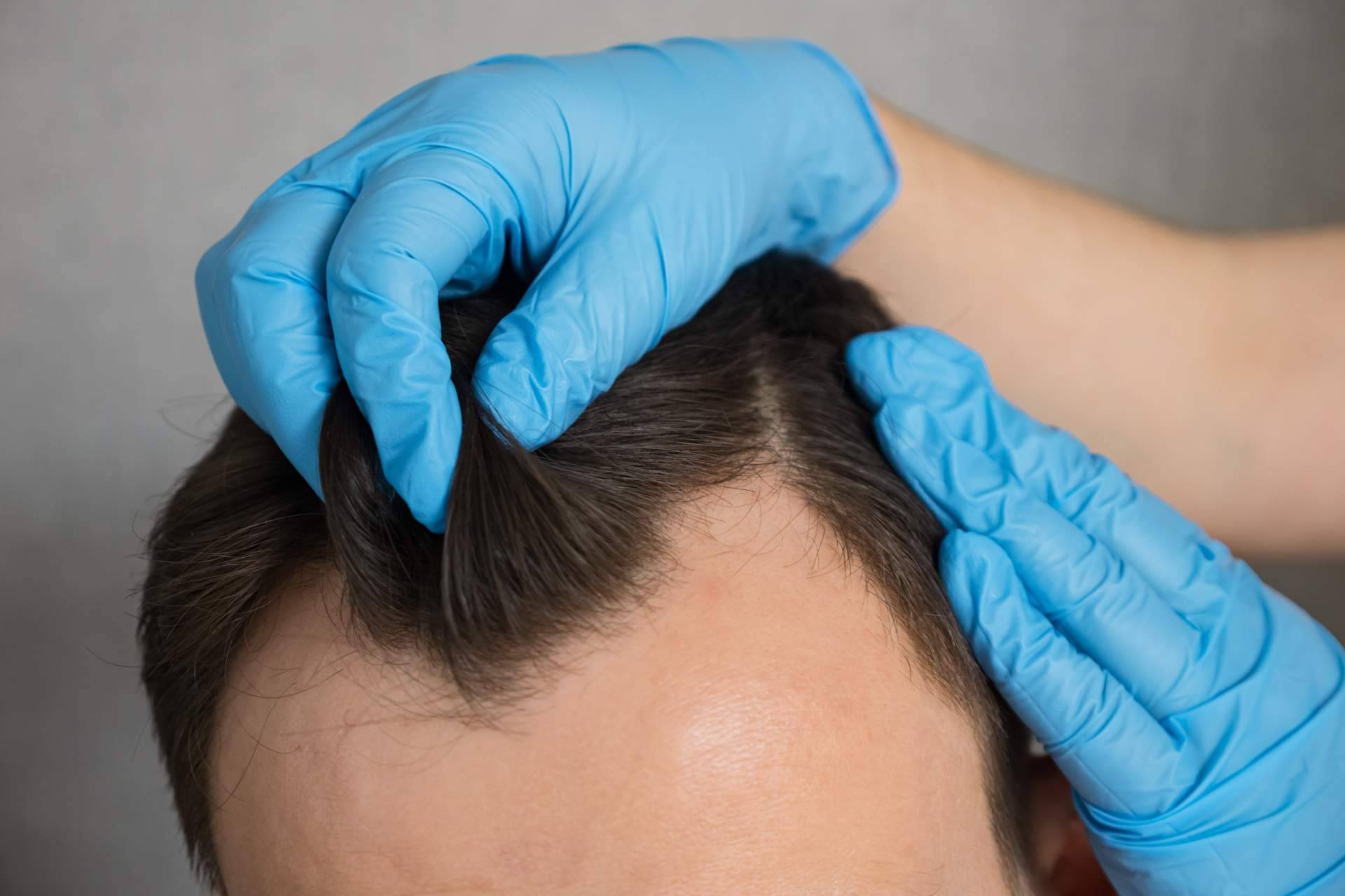 Clínica Capilar Mora ofrece últimas plazas para trasplante capilar con enfoque médico y resultado natural